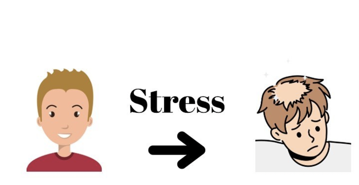Alopecia areata stress deals